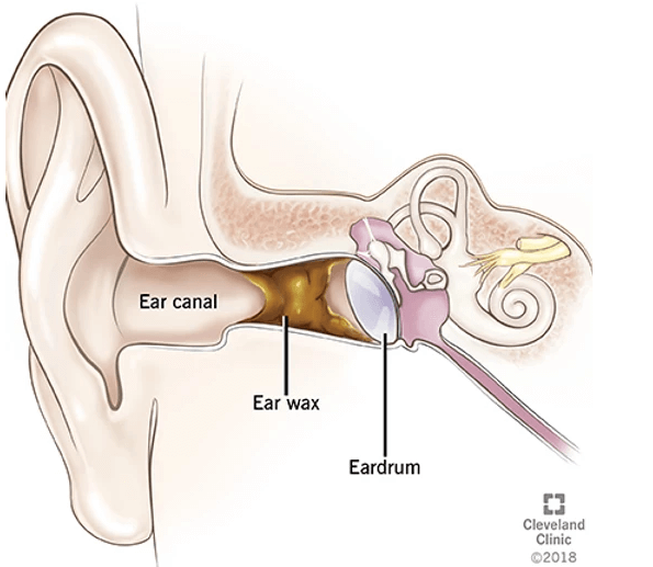 Featured image for “<strong>Hearing Loss or Earwax?</strong>”