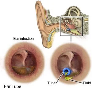 Featured image for “What Are Tubes In Your Ears?”